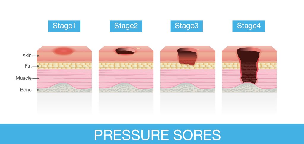 An Example Of Harm and Abuse: Bed Sores Pressure Ulcers